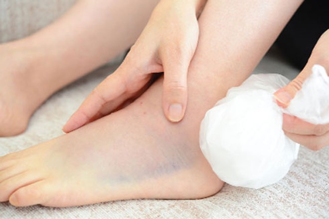 Tổng hợp những điều cần biết về bong gân cổ chân - Ảnh 3. Tổng hợp những điều cần biết về bong gân cổ chân - Ảnh 3.
