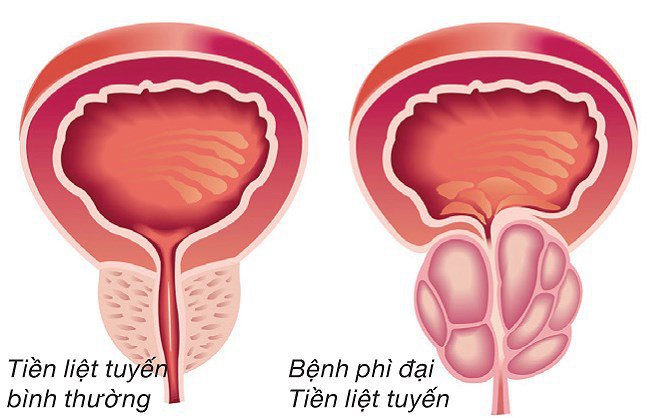 Phì đại tuyến tiền liệt là bệnh gì? Từ A đến Z về bệnh phì đại tuyến tiền liệt - Ảnh 2. Phì đại tuyến tiền liệt là bệnh gì? Từ A đến Z về bệnh phì đại tuyến tiền liệt - Ảnh 2.