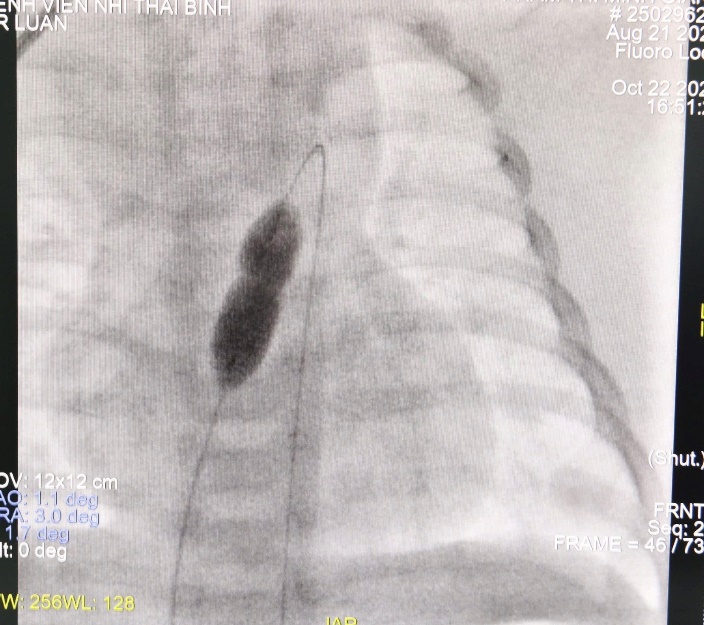 C:\Users\CTXH2732025\Desktop\tin nong mạch phổi 12.11\4.jpg