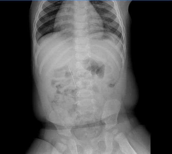 Bệnh viện Nhi Thái Bình: Gắp thành công cây kim trong tá tràng bé 11 tháng tuổi- Ảnh 1. Bệnh viện Nhi Thái Bình: Gắp thành công cây kim trong tá tràng bé 11 tháng tuổi- Ảnh 1.