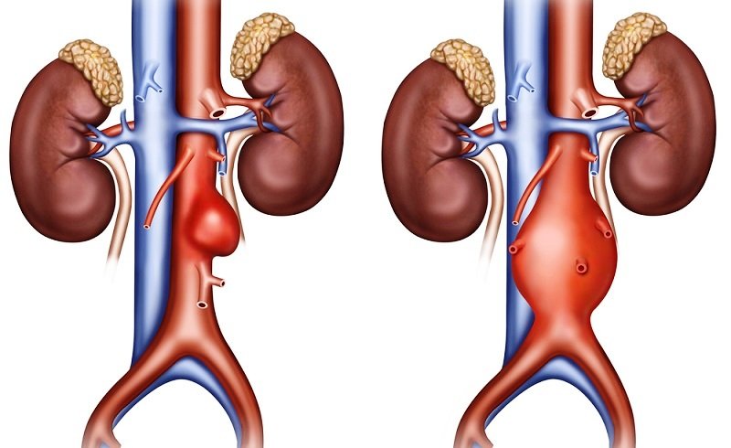 Phát hiện phình động mạch chủ bụng nguy hiểm sau cơn đau bụng- Ảnh 1.
