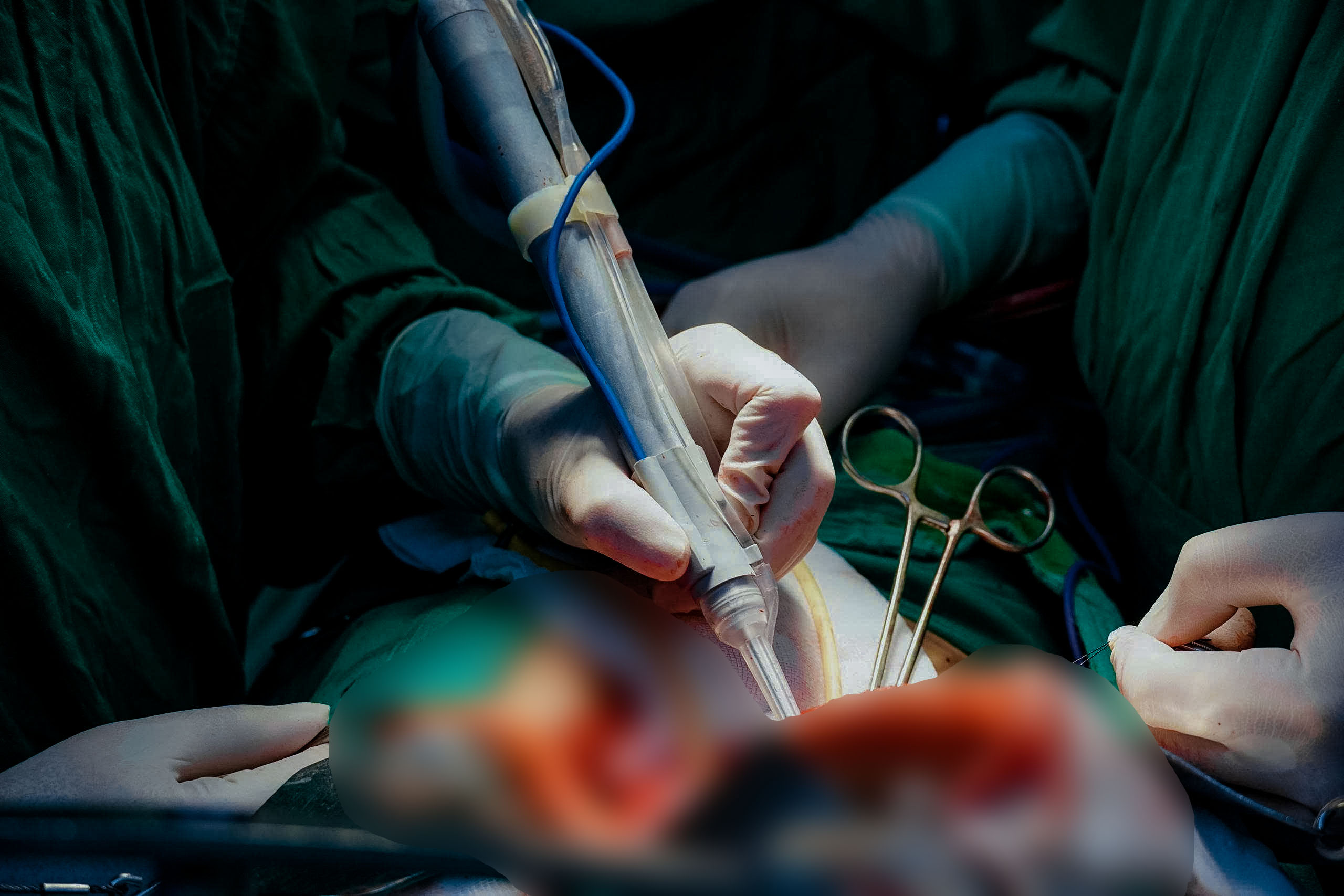 Bệnh viện Đa khoa Trung ương Cần Thơ: Sử dụng dao mổ siêu âm CUSA trong ...