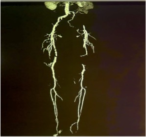 Cần Thơ: Bệnh nhân 70 tuổi giữ được chân nhờ can thiệp nội mạch- Ảnh 1.