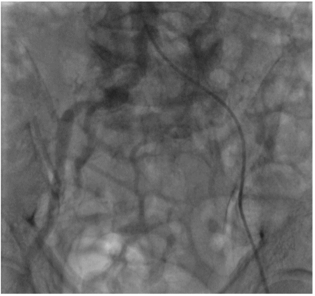 Cần Thơ: Bệnh nhân 70 tuổi giữ được chân nhờ can thiệp nội mạch- Ảnh 2.