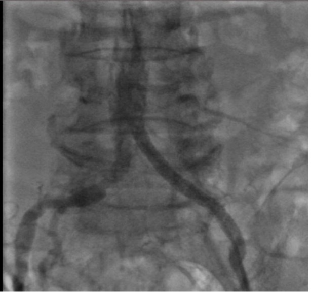 Cần Thơ: Bệnh nhân 70 tuổi giữ được chân nhờ can thiệp nội mạch- Ảnh 4.