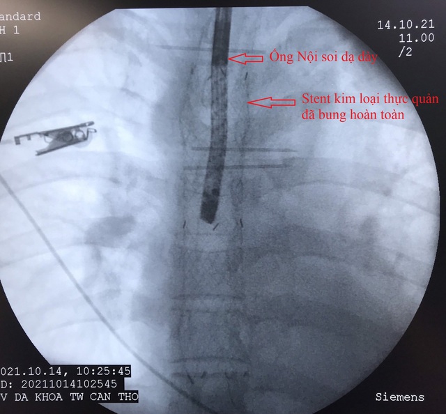 Nội soi thực hiện đặt stent kim loại tại chỗ thủng thực quản.