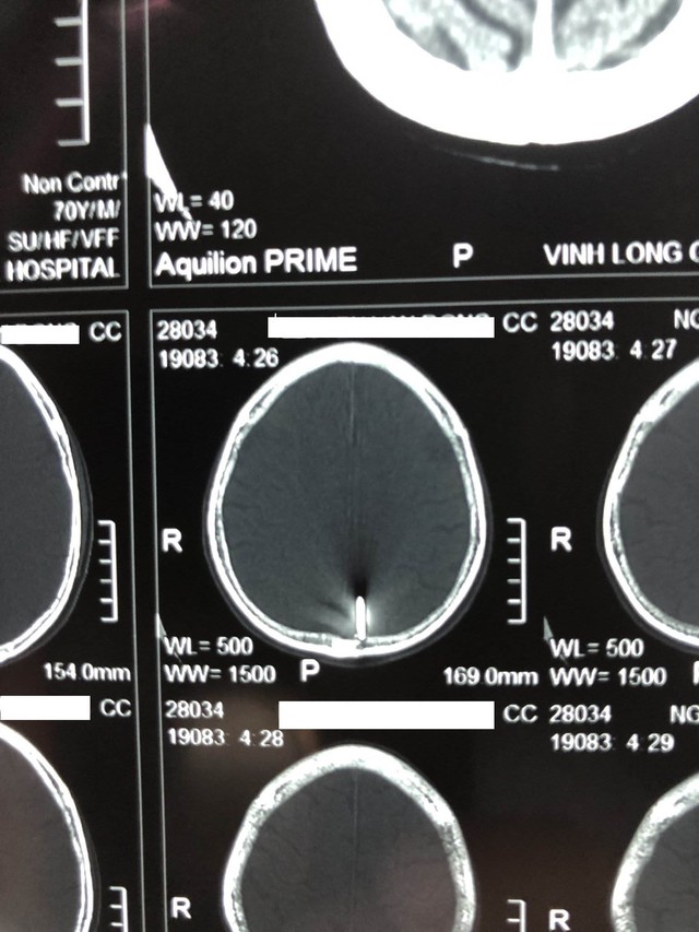 Hình ảnh cây đinh trên phim chụp cắt lớp vi tính sọ não.