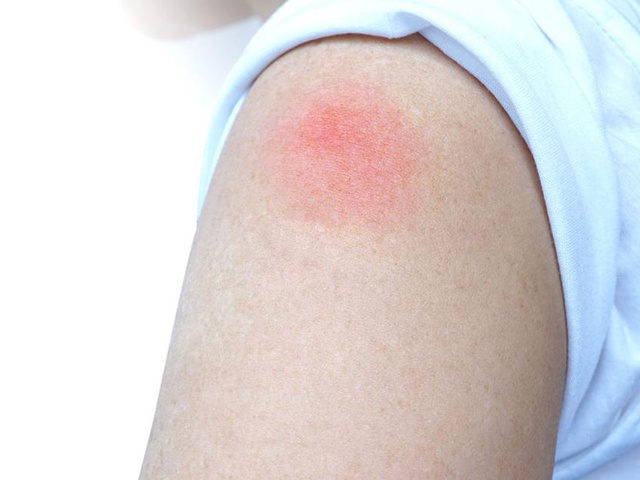Phản ứng “cánh tay COVID-19” sau tiêm vaccine ở trẻ: Cha mẹ cần nhớ điều này - Ảnh 1.