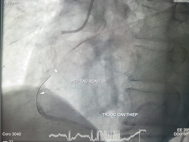 Hình ảnh DSA mạch vành trước can thiệp.