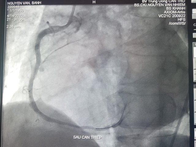 Hình ảnh DSA mạch vành sau can thiệp.