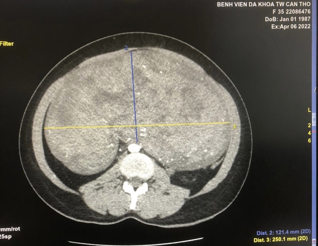 Kích thước khối u trên phim chụp cắt lớp vi tính có cản quang.