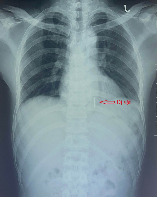 Hình ảnh dị vật trên phim X-quang tim phổi.