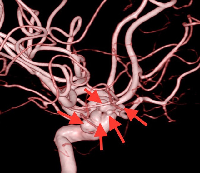 Các vị trí túi phình mạch máu não của bà T., hình ảnh trên DSA