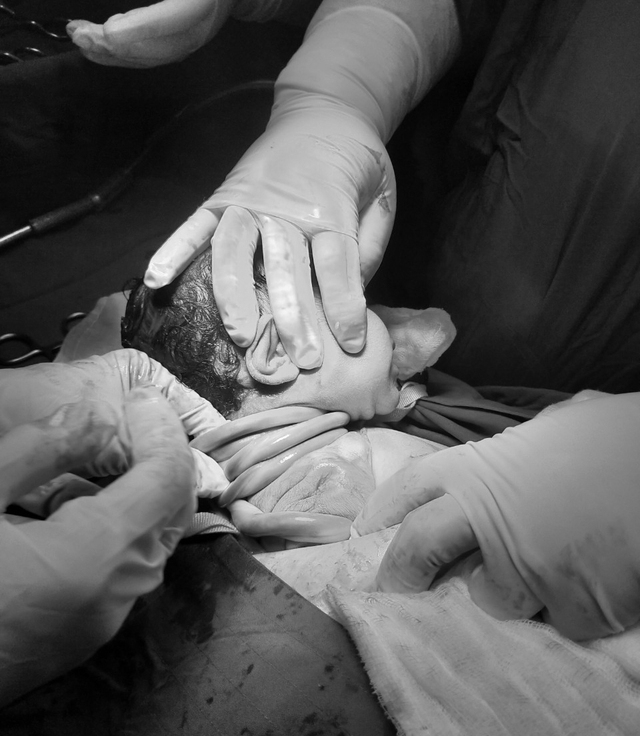 Em bé bị dây rốn quấn quanh cổ 5 vòng chào đời an toàn tại Trung tâm Y tế huyện Vĩnh Thuận.