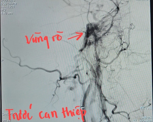 Hình ảnh rò động mạch cảnh - xoang hang trên hình chụp mạch máu số hóa xóa nền.