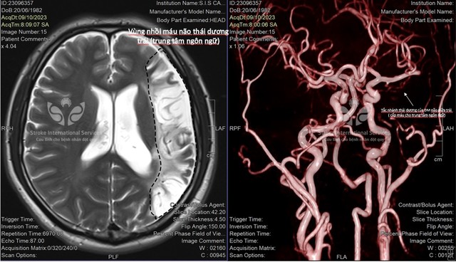 Vị trí tổn thương trên não thường là thùy thái dương bên trái (trung tâm ngôn ngữ) của anh T.A.
