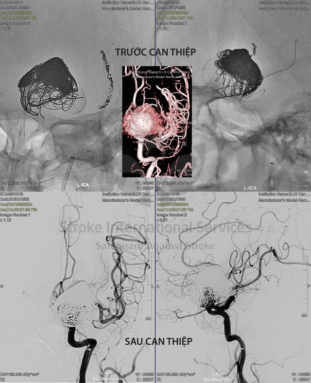Túi phình mạch máu não của bà S. được dựng hình 3D