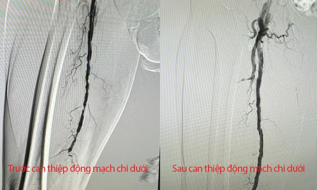 Cần Thơ: Đặt stent cho cụ ông bị hẹp nặng động mạch chi dưới- Ảnh 2.