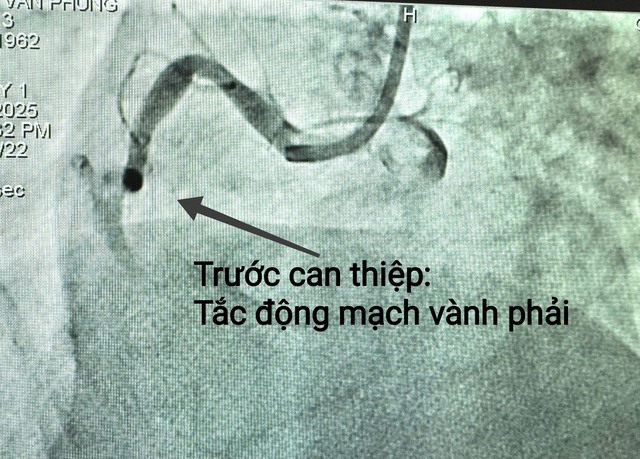 Cần Thơ: Kịp thời cứu sống bệnh nhân nhồi máu cơ tim nguy kịch- Ảnh 1.