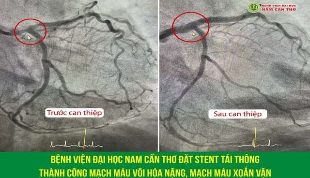 Bệnh lý tim mạch và các biện pháp phòng ngừa- Ảnh 4. Bệnh lý tim mạch và các biện pháp phòng ngừa- Ảnh 4.