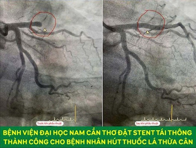 Bệnh lý tim mạch và các biện pháp phòng ngừa- Ảnh 2. Bệnh lý tim mạch và các biện pháp phòng ngừa- Ảnh 2.