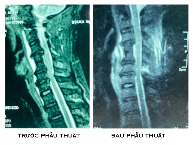 Thái Bình: Ứng dụng nội soi điều trị hẹp ống sống cổ, bước tiến mới trong y học hiện đại- Ảnh 2. Thái Bình: Ứng dụng nội soi điều trị hẹp ống sống cổ, bước tiến mới trong y học hiện đại- Ảnh 2.
