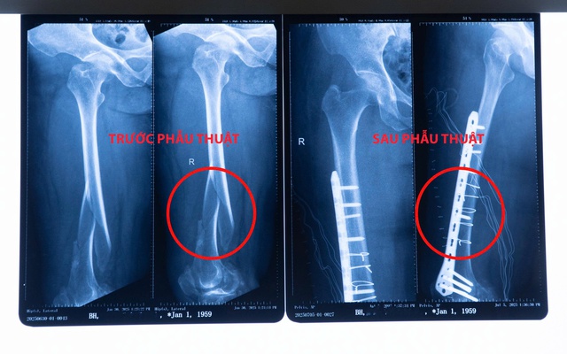 BV Đại học Nam Cần Thơ: Phẫu thuật thành công cho bệnh nhân gãy nát xương đùi phải- Ảnh 1. BV Đại học Nam Cần Thơ: Phẫu thuật thành công cho bệnh nhân gãy nát xương đùi phải- Ảnh 1.