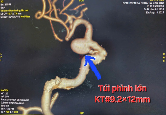 Bệnh viện Đa khoa Trung ương Cần Thơ: Can thiệp thành công túi phình mạch não cho cụ bà 90 tuổi- Ảnh 2. Bệnh viện Đa khoa Trung ương Cần Thơ: Can thiệp thành công túi phình mạch não cho cụ bà 90 tuổi- Ảnh 2.