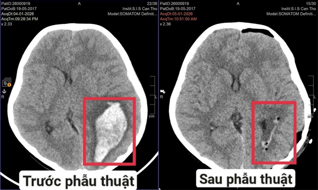 Cứu sống trẻ xuất huyết não do vỡ dị dạng mạch máu não- Ảnh 1.
