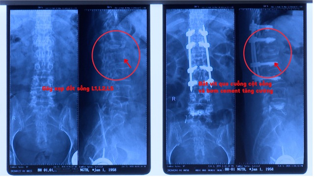 Té ngã nhưng hậu quả nặng do chủ quan, điều trị muộn- Ảnh 2.