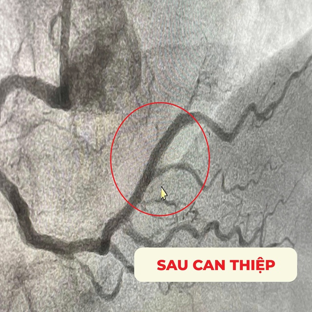 Can thiệp thành công cho một trường hợp tái hẹp nặng trong stent mạch vành đã đặt ở Hàn Quốc- Ảnh 2.