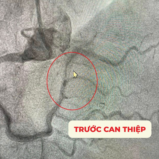 Can thiệp thành công cho một trường hợp tái hẹp nặng trong stent mạch vành đã đặt ở Hàn Quốc- Ảnh 1.