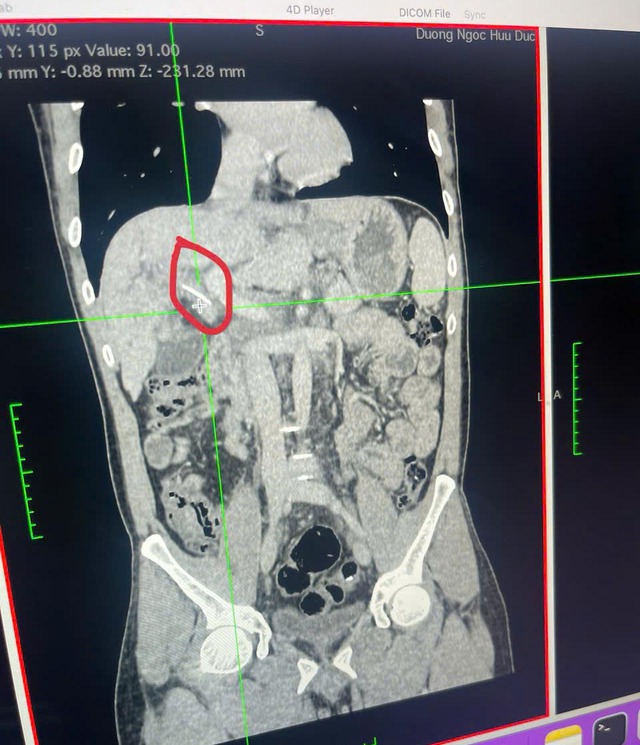Hy hữu xương cá 3cm xuyên vào đường mật- Ảnh 2. Hy hữu xương cá 3cm xuyên vào đường mật- Ảnh 2.