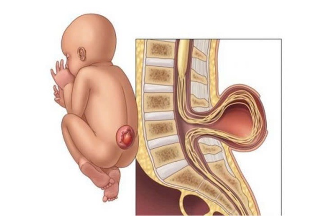 Cứu trẻ dị tật hiếm gặp: Bệnh viện Nhi Thái Bình lần đầu phẫu thuật thành công thoát vị màng não tủy- Ảnh 2.