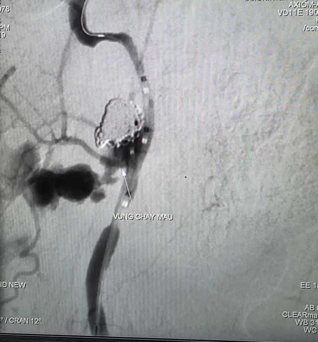Kịp thời cứu sống một trường hợp xuất huyết nặng do ung thư vòm hầu xâm lấn động mạch cảnh trong- Ảnh 1.