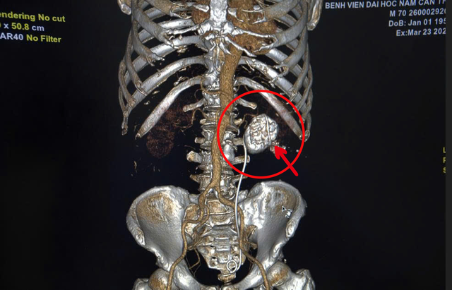 Phẫu thuật thành công cho bệnh nhân người Campuchia bị sỏi thận san hô to, khối lượng lớn- Ảnh 1.