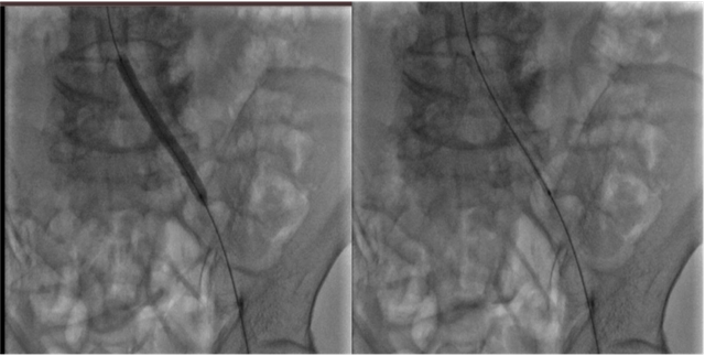Cần Thơ: Bệnh nhân 70 tuổi giữ được chân nhờ can thiệp nội mạch- Ảnh 3.