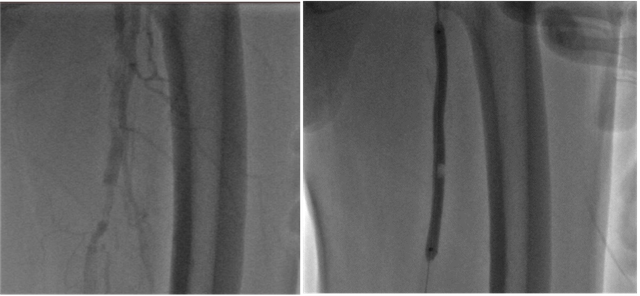 Cần Thơ: Bệnh nhân 70 tuổi giữ được chân nhờ can thiệp nội mạch- Ảnh 5.