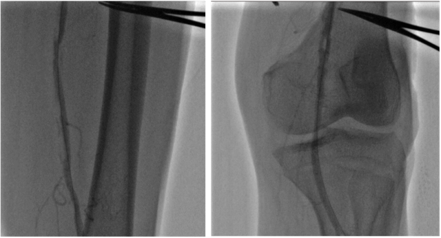 Cần Thơ: Bệnh nhân 70 tuổi giữ được chân nhờ can thiệp nội mạch- Ảnh 6.