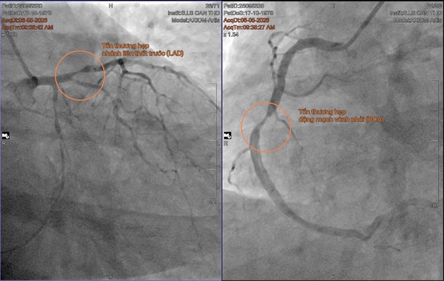 BVĐK Quốc tế SIS Cần Thơ: Lần đầu tiên đặt stent tự tiêu cho bệnh nhân nhồi máu cơ tim- Ảnh 1.