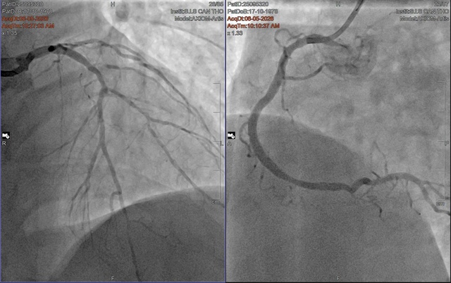 BVĐK Quốc tế SIS Cần Thơ: Lần đầu tiên đặt stent tự tiêu cho bệnh nhân nhồi máu cơ tim- Ảnh 2.