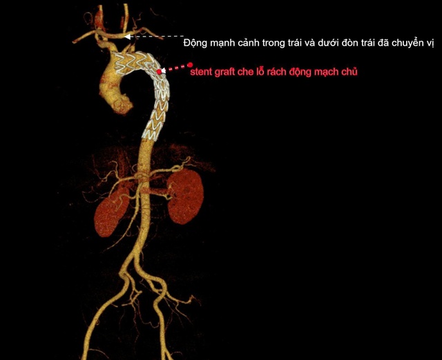 Cứu sống bệnh nhân bóc tách động mạch chủ đã vỡ - Ảnh 2.