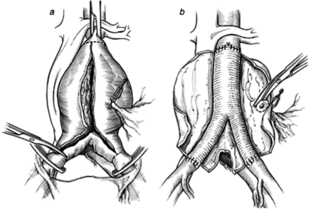 Nghẹt thở cứu sống bệnh nhân khỏi “quả bom nổ chậm” trong bụng- Ảnh 3.
