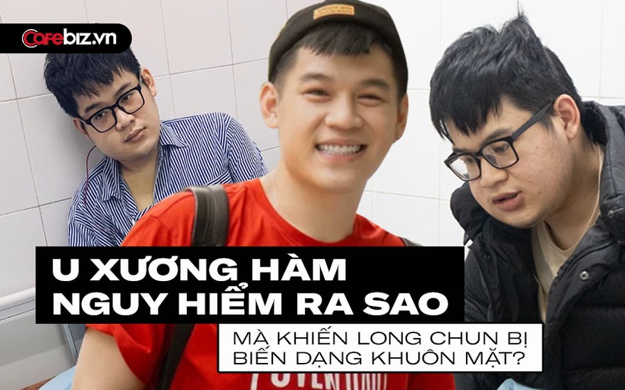 3 triệu chứng KINH ĐIỂN của u xương hàm - Căn bệnh từng khiến Long Chun bị BIẾN DẠNG gương mặt