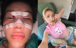 Ngân 98 lạm dụng phẫu thuật thẩm mỹ, hệ quả ra sao?