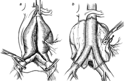 Nghẹt thở cứu sống bệnh nhân khỏi “quả bom nổ chậm” trong bụng