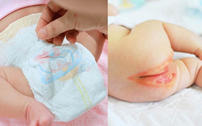 Nguy hại từ bỉm hết hạn sử dụng | Tã bỉm Bonbaby, Bỉm Bondbaby UK, bỉm Bonbaby Cá Heo